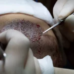 FUE, DHI ou FUT : quelle technique de greffe de cheveux choisir