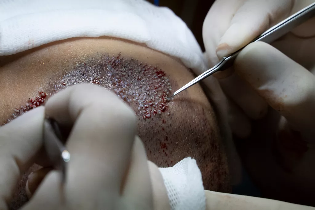 FUE, DHI ou FUT : quelle technique de greffe de cheveux choisir
