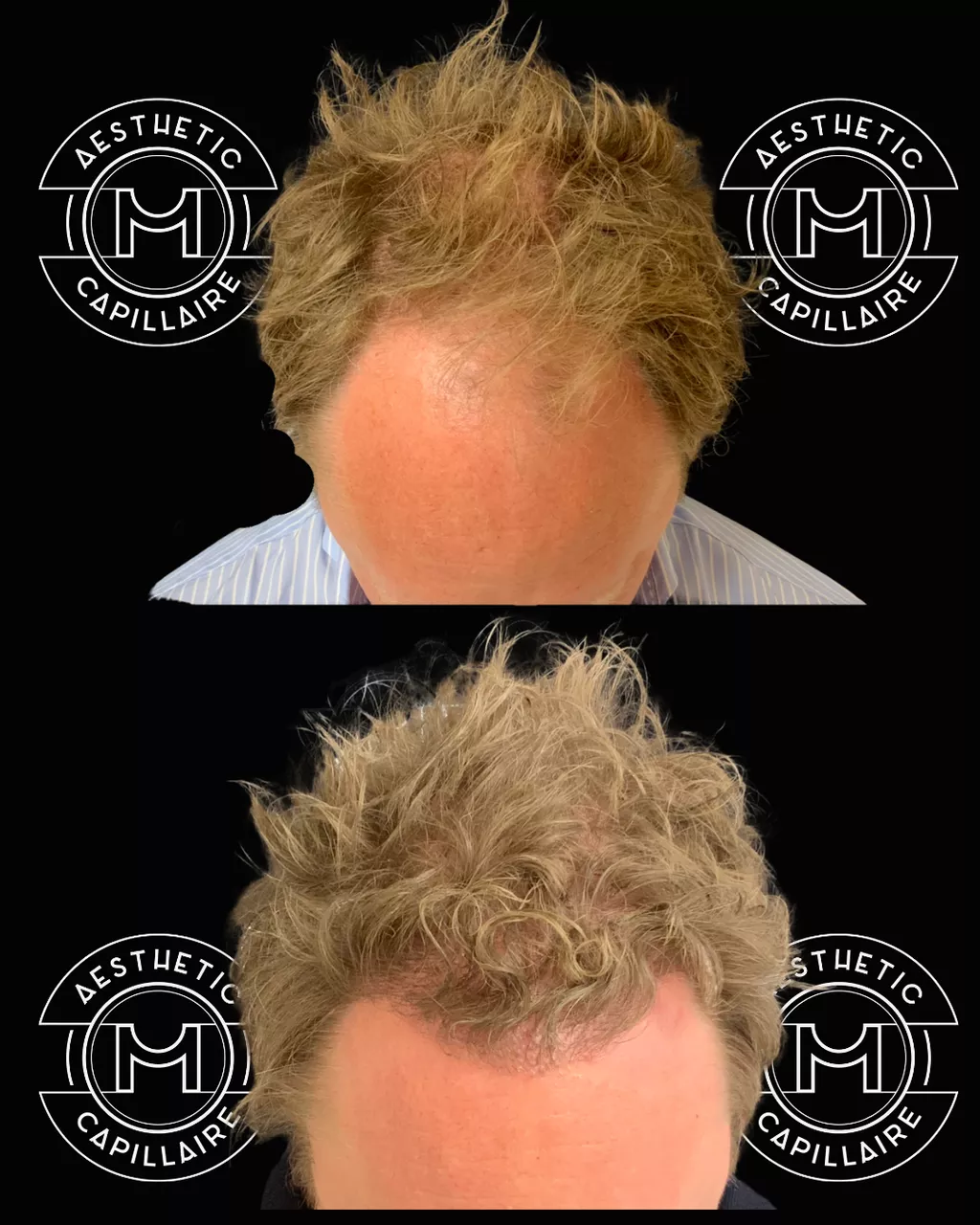 Avant après greffe de cheveux