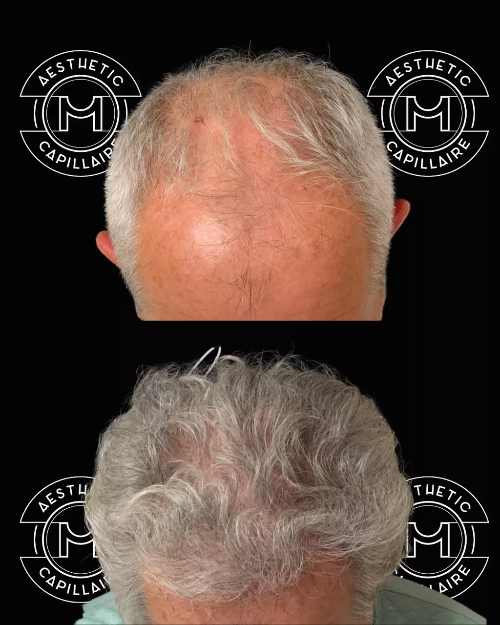 Avant après greffe de cheveux