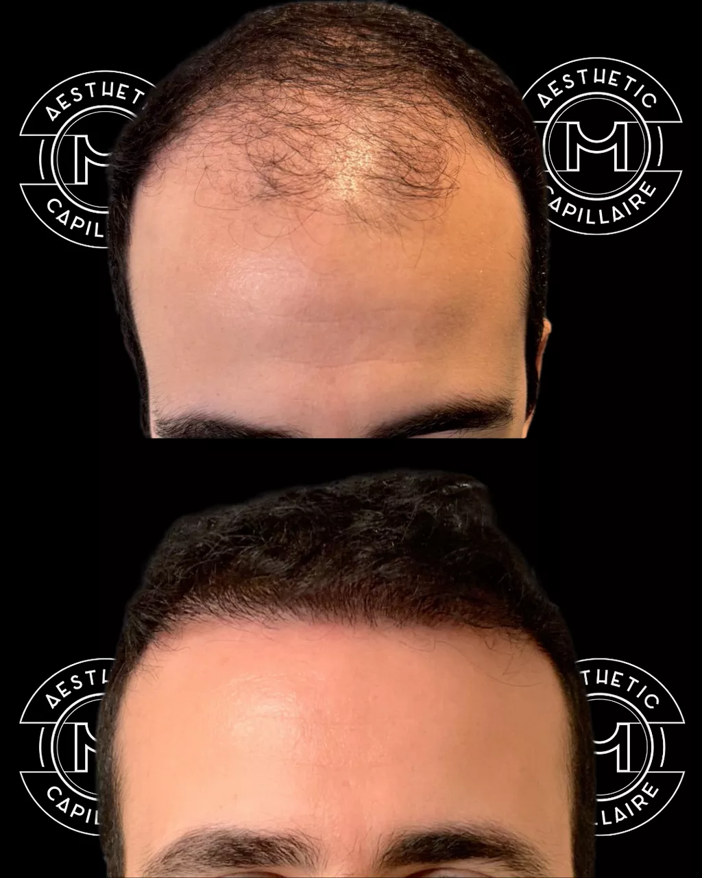 Avant après greffe de cheveux