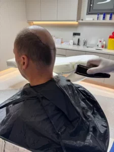 Préparation de la zone donneuse