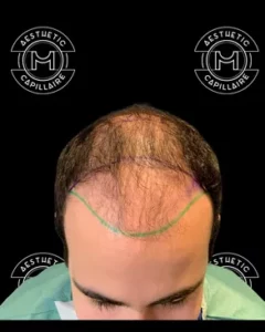 Préparation de la zone receveuse