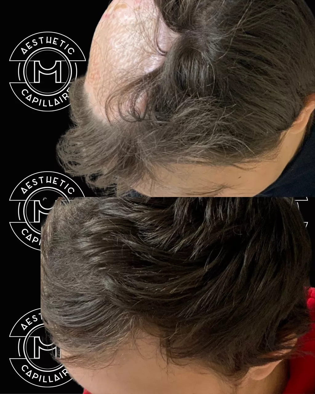 Avant après greffe de cheveux