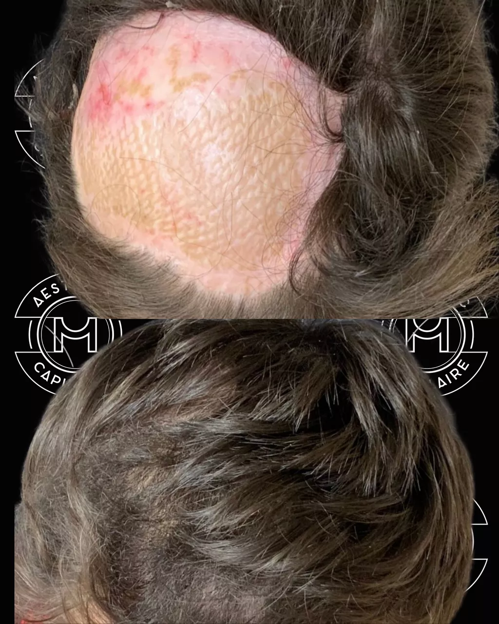 Avant après greffe de cheveux