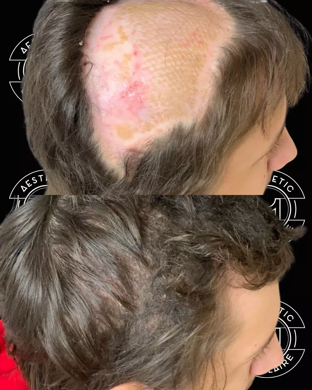 Avant après greffe de cheveux