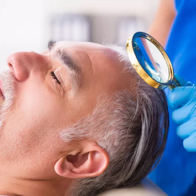 Tout savoir sur la repousse après une greffe de cheveux